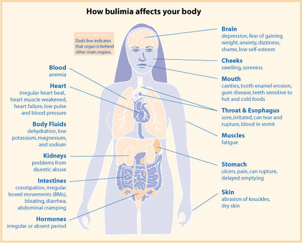 Bulimia Facts