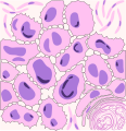Rappresentazione A Carcinoma squamocellulare: sono presenti numerose spine tra cellula e cellula. Una perla cornea è parzialmente rappresentata nell'angolo in basso a destra.