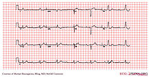 E312 (CardioNetworks ECGpedia).jpg