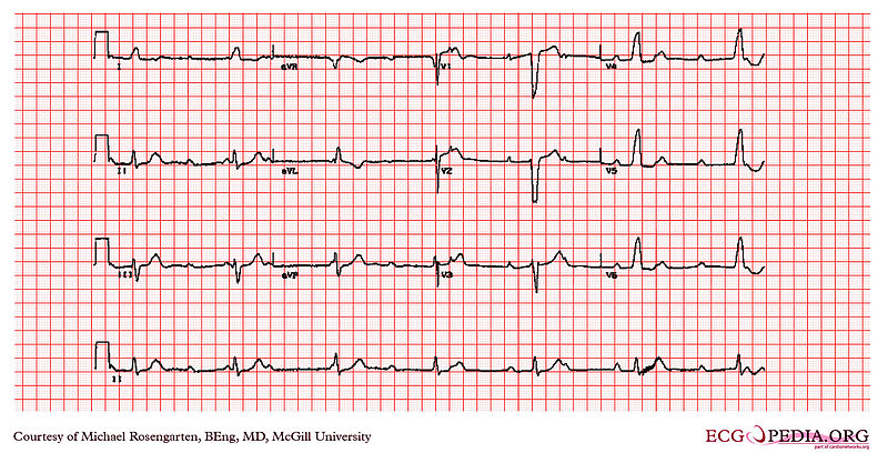 File:E312 (CardioNetworks ECGpedia).jpg