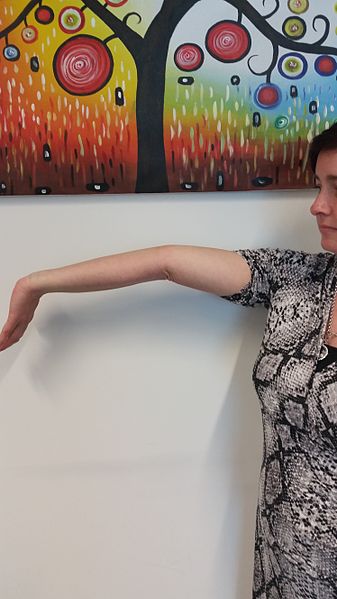 File:Elbow hyperextension.jpg