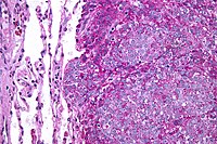 Ewing sarcoma