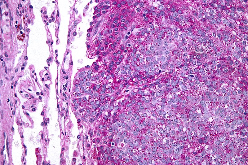 File:Ewing sarcoma - PAS - very high mag.jpg