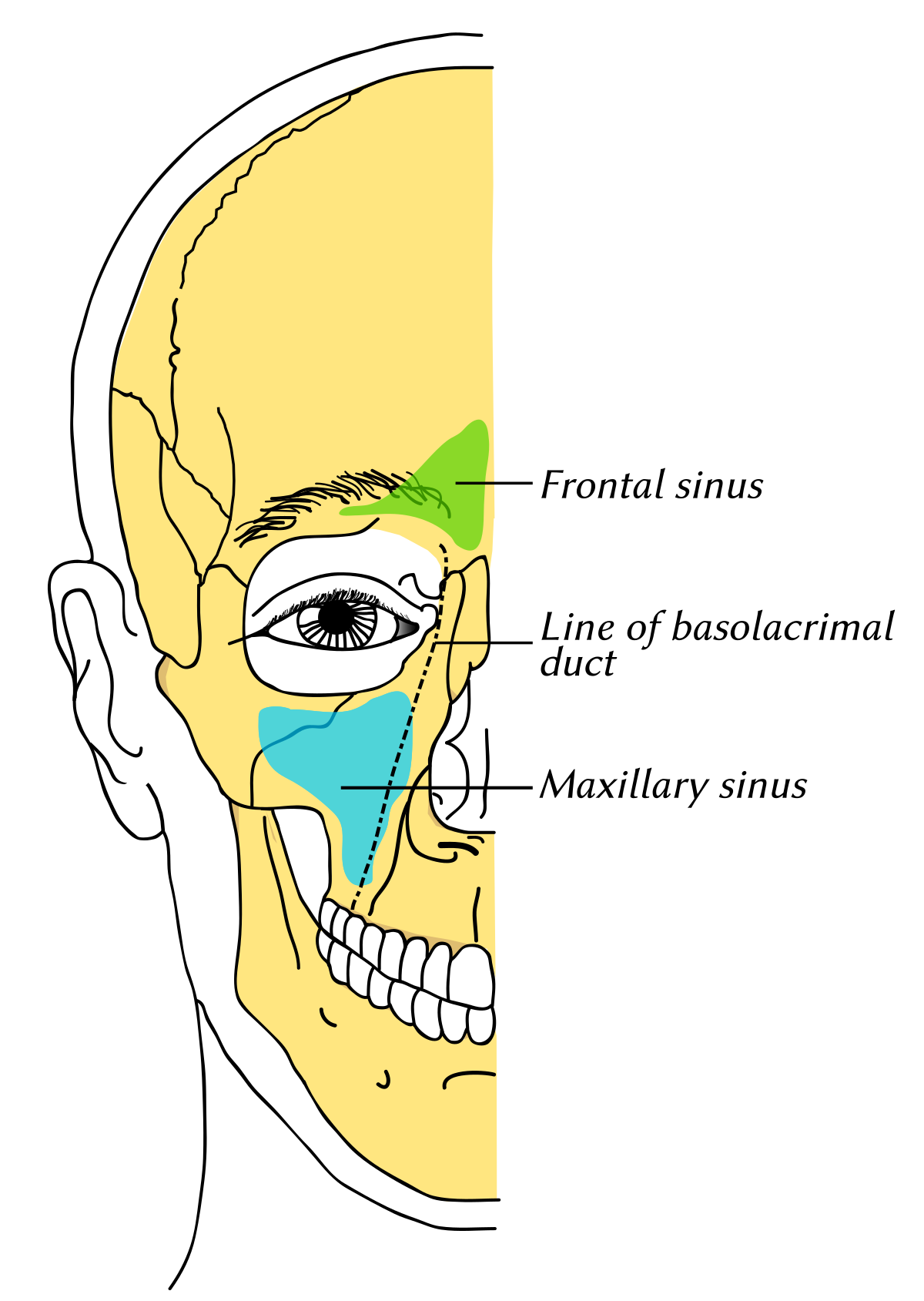 orsóféreg a maxilláris sinusban)