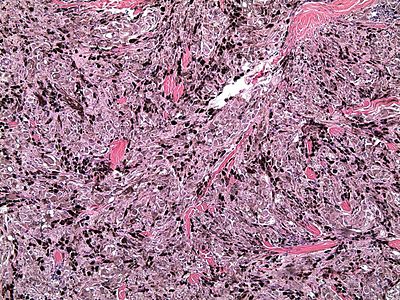 Perianal gray horse melanoma, histology of tumor Grey horse melanoma 1.JPG