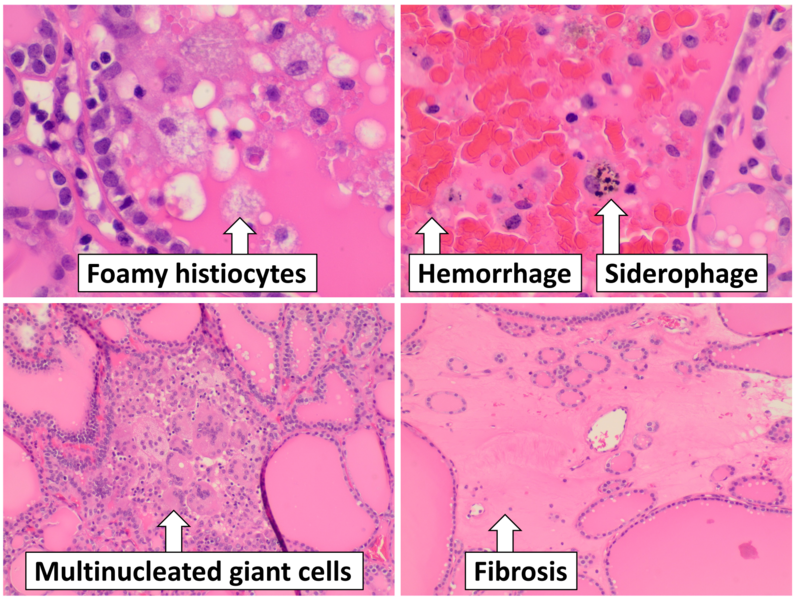 File:Histopathology of degenerative changes in thyroid hyperplasia.png