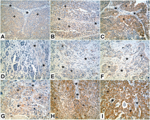 Invasive urothelial carcinoma.png