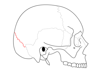 <span class="mw-page-title-main">Lambdoid suture</span> Connective tissue between the parietal bones and the occipital bone of the skull