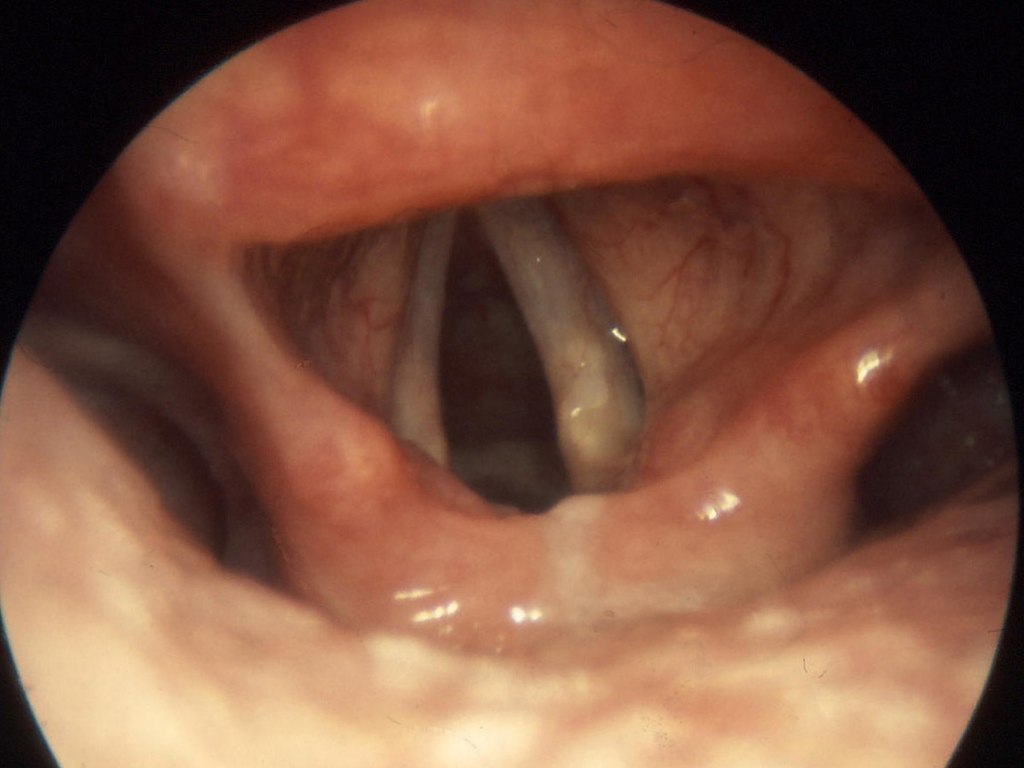 Larynx normal2a