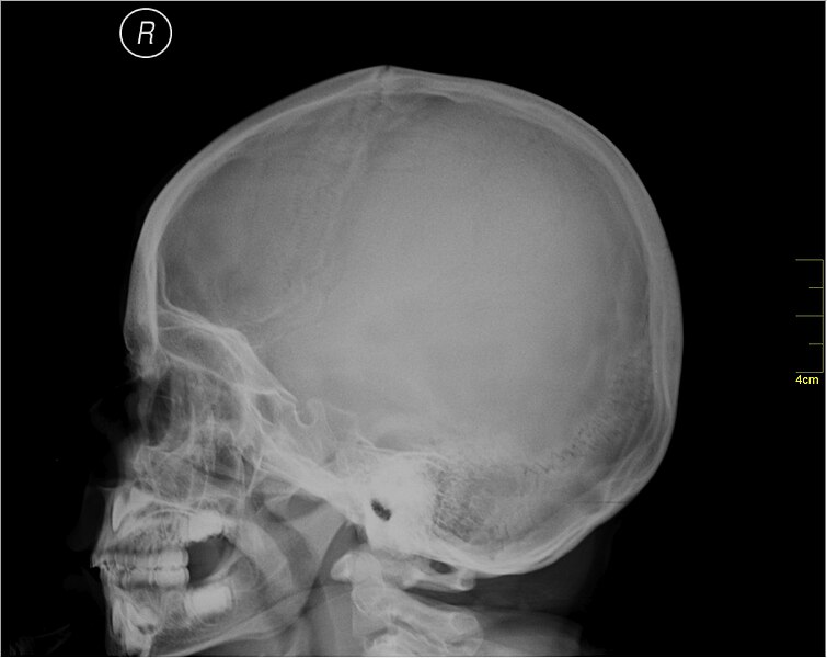 File:Medical X-Ray imaging QQJ06 nevit.jpg