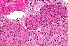 Micrograph of a meningioma with brain invasion (WHO Grade II). The tumour (bottom/right of image) has the typical "pushing border" invasion into the cerebral cortex (top/left of image), HPS stain. Meningioma - brain invasion - high mag.jpg