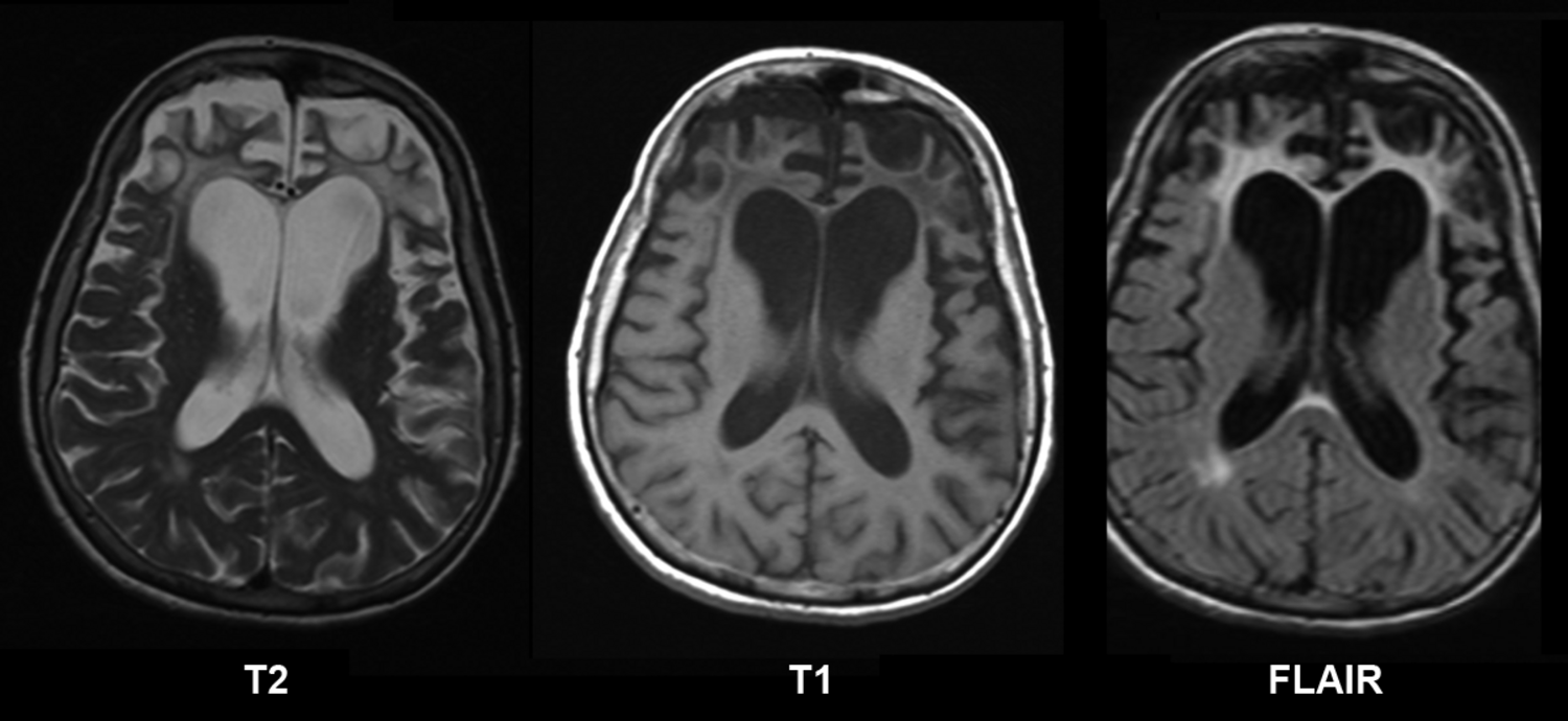 Doença de Alzheimer – Wikipédia, a enciclopédia livre