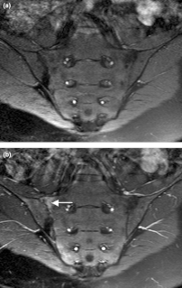 Sacroiliitis Medical condition