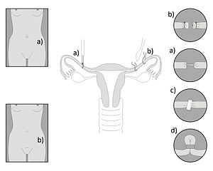 Tubal ligation - Nonbinary Wiki