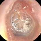 Retracted eardrum Wiki TM retraction.jpg