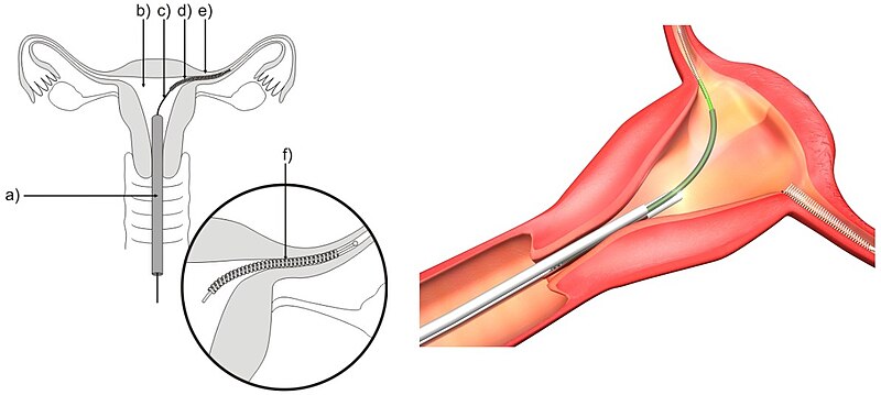 File:Zavádění spirály Essure.jpg