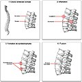 Evolution de la Spondylarthrite ankylosante