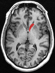 ภาพตัดขวาง (Transverse) ของนิวเคลียสมีหางทำด้วย MRI
