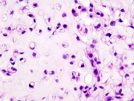 Chondrosarcoma (4).jpg