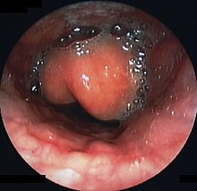 Epiglottitis as seen during endoscopy
