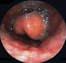Endoskopický obraz epiglotitidy