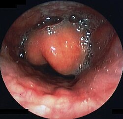 Swollen epiglottis in laryngoscopy