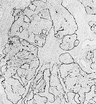 <span class="mw-page-title-main">Esthesioneuroblastoma</span> Medical condition