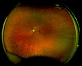 Thumbnail for Scanning laser ophthalmoscopy