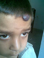 Hemangioma on forehead showing signs of early regression