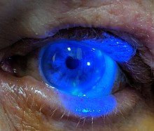 Herpes zoster ophthalmicus as seen after fluorescence staining using cobalt blue light HerpesZosterOpth.jpg