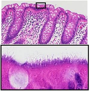 Histopathology of intestinal spirochetosis.jpg