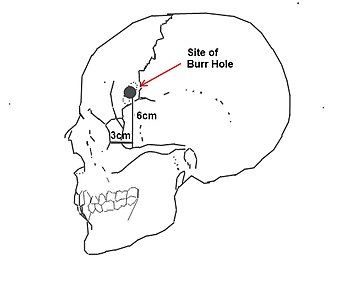 Site of borehole for the standard pre-frontal lobotomy/leucotomy operation as developed by Freeman and Watts