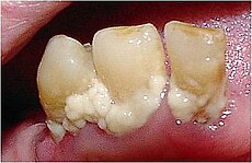 Plaque-Tooth.jpg