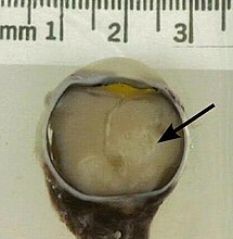 A retinoblastoma as seen in an eye removed from a 3-year-old female