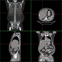 Hepatomegali tomografisi.