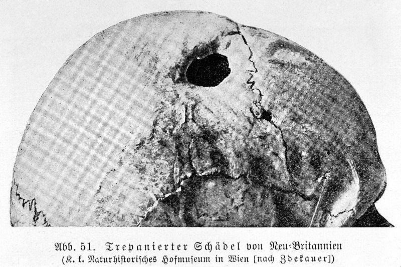 File:Trepanned skull, New Britain Wellcome M0005286.jpg