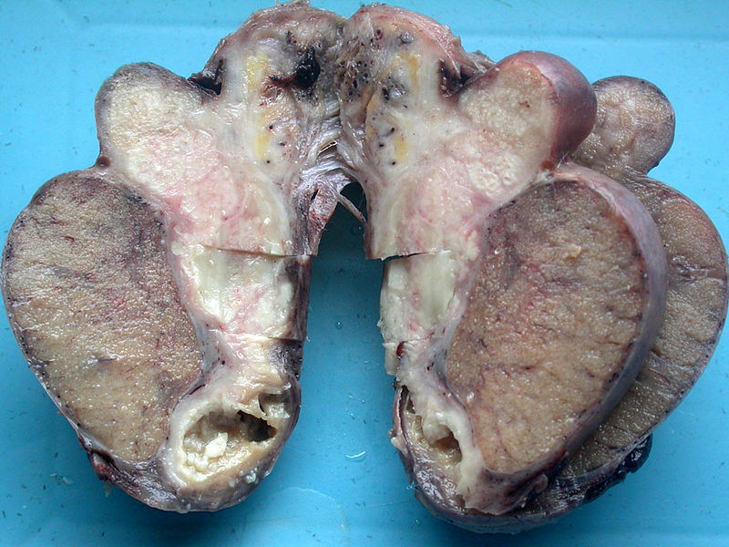 File:Tuberculous epididymoorchitis gross pathology.jpg