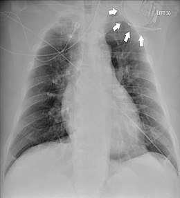 Beschreibung des Bildes Twiddler-Syndrom.jpg.