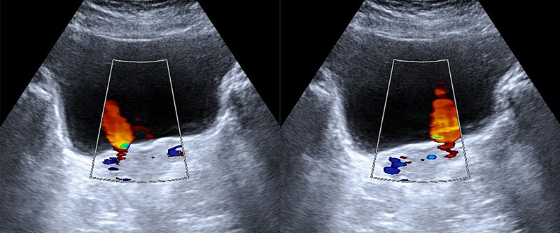 File:Ureterjet im Farbdoppler 27W - US - 001.jpg