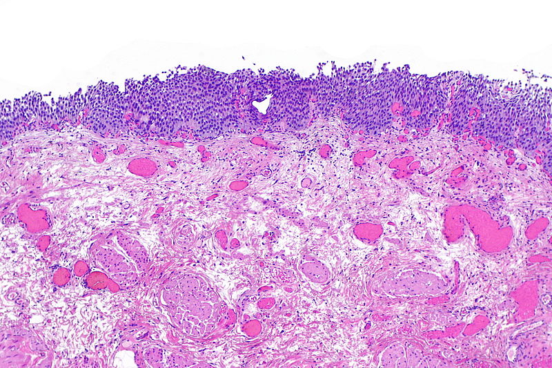 File:Urothelial dysplasia -- low mag.jpg