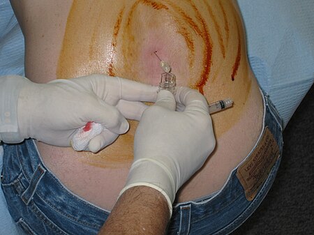 Wikipedian getting a lumbar puncture (2006).jpg