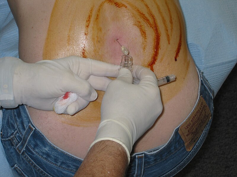 File:Wikipedian getting a lumbar puncture (2006).jpg