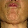 Fig. 13. Déglutition salivaire nonante seconde après la Fig. 9' : bouche sèche et contractions musculaires plus intenses (plastron mentonnier).