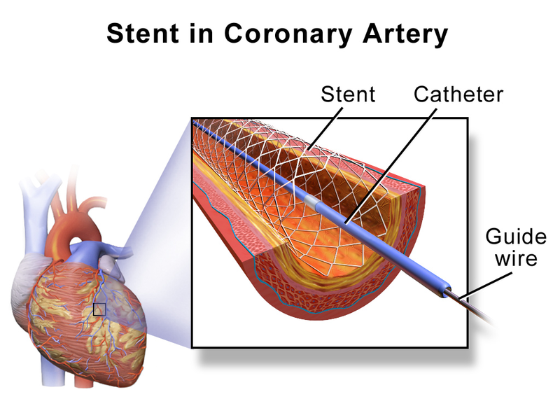 File:Blausen 0034 Angioplasty Stent 01.png