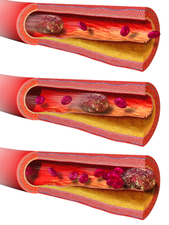 Embolus Unattached mass that travels through the bloodstream