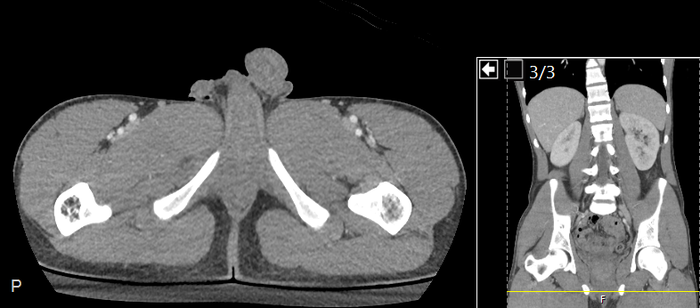 CT of a normal abdomen and pelvis, axial plane 298.png