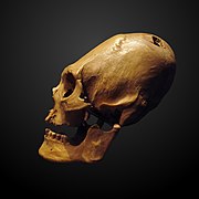 Deformed trepanated skull-ETHAM 019484