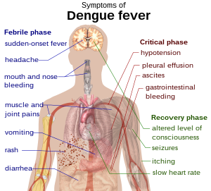 Скица на човечко торзо со стрелки кон органите што се под влијание на денгата во нејзините различни етапи