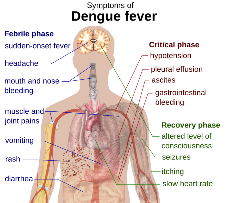 ไฟล์:Dengue fever symptoms.svg