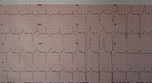 Elektrokardiogram pacienta s funkčnou dvojdutinovou kardiostimuláciou.
